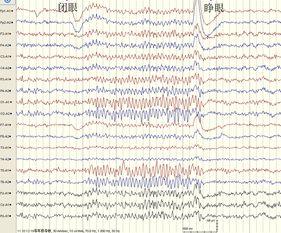 成人数字视频脑电图