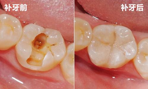 蛀牙补牙视频成人,成人的牙齿修复之旅
