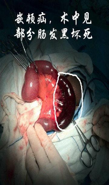 成人疝气的手法视频,成人疝气手法治疗技巧解析