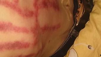 成人发烧扯痧视频讲解,专业扯痧视频教程解析